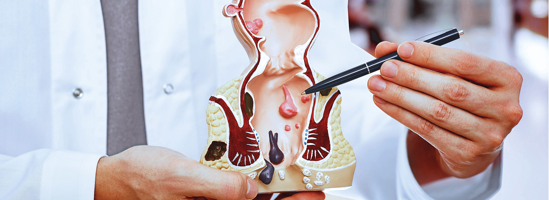 Ärztliche Erklärung proktologischer Erkrankungen anhand eines anatomischen Modells des Enddarms und Afters.