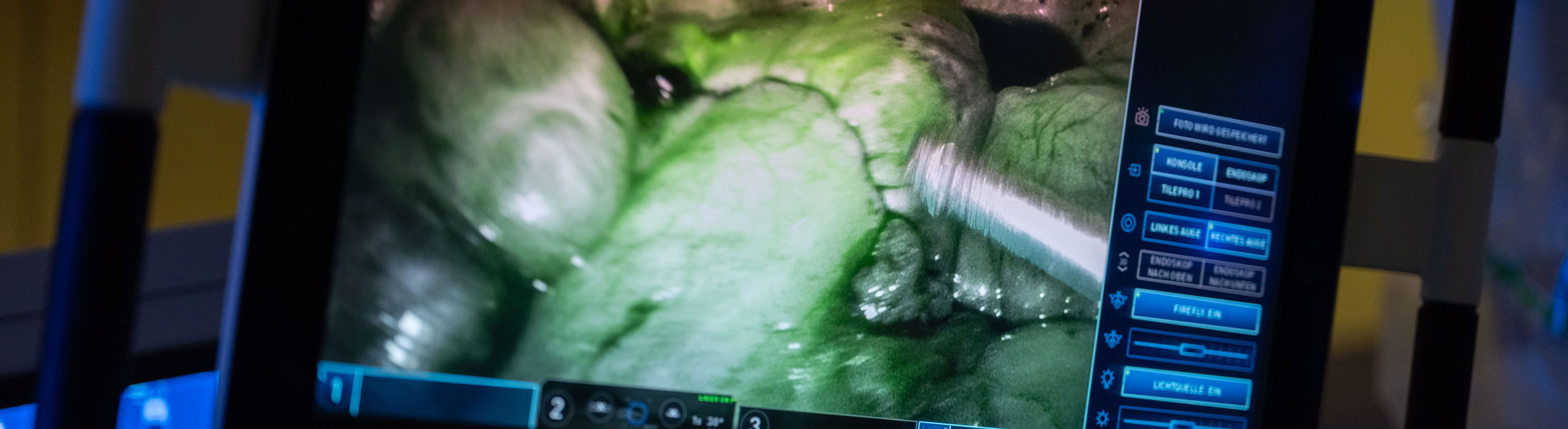 3D-Operationsansicht während einer robotisch assistierten Operation mit ICG-Fluoreszenz am daVinci X-System.
